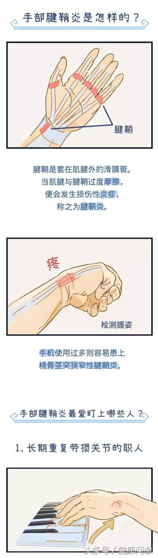 这些人都有可能得腱鞘炎!日常生活里该如何保养?
