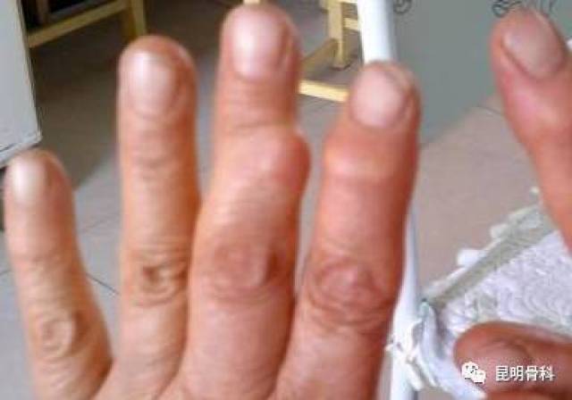 手指骨质增生症状图片图片