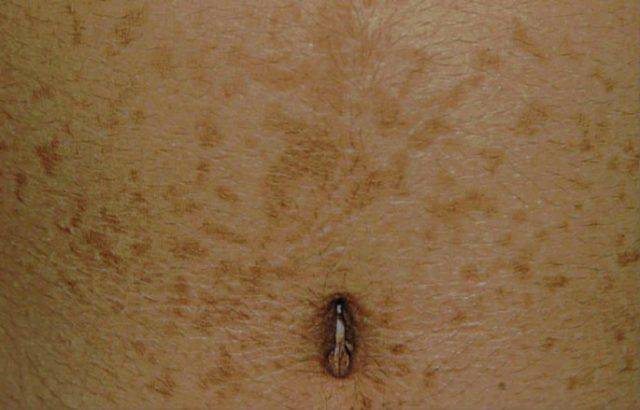 脐周散在淡褐色斑疹或斑片,局部融合成网状