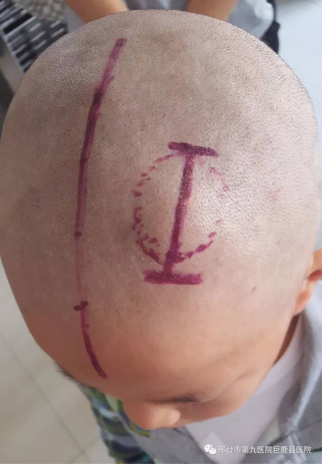 头皮粉瘤手术刀口图片图片