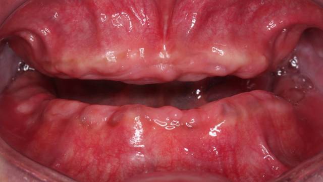 全口无牙颌数字化导航与修复病例