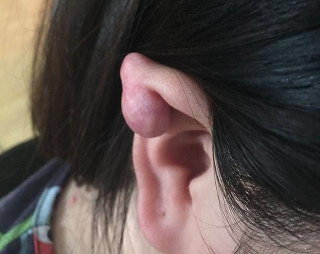 耳朵软骨瘤症状图片图片
