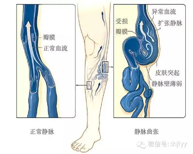 腿上的青筋需要治疗吗