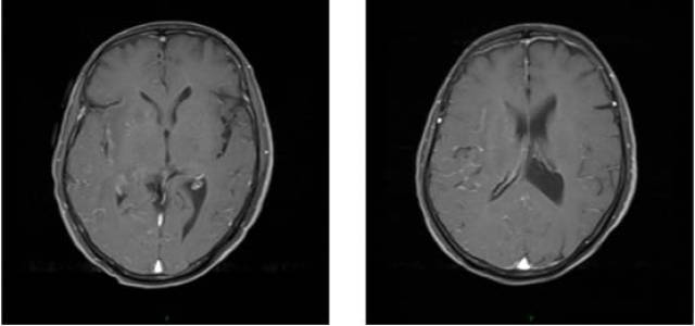 MRI对病毒性脑炎的检测率低?可能是你的