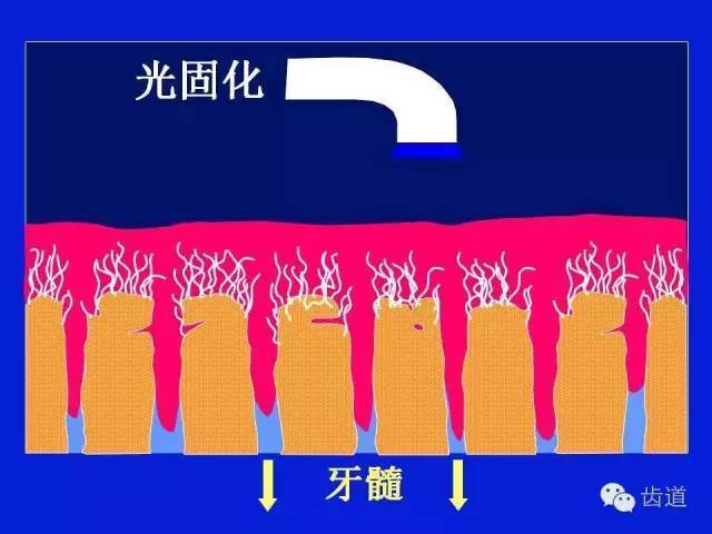 粘接劑(bonding) 牙釉質,牙本質 底膠 樹脂共聚 混合層(hubrid layer)