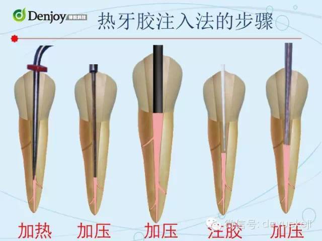 【现代根管治疗】之热牙胶充填技术