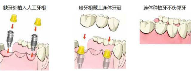 补门牙图片,门牙蛀牙修补前后图片,树脂补前门牙成图片_大山谷图库