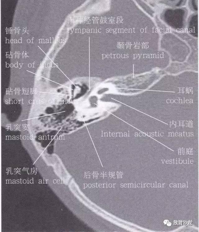 颞骨岩部断层解剖图图片