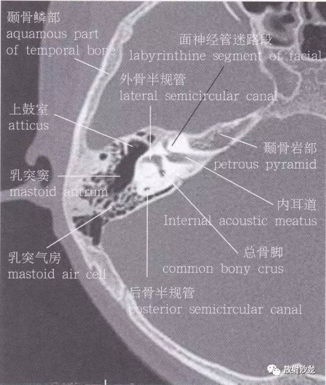 颞骨岩部断层解剖图图片