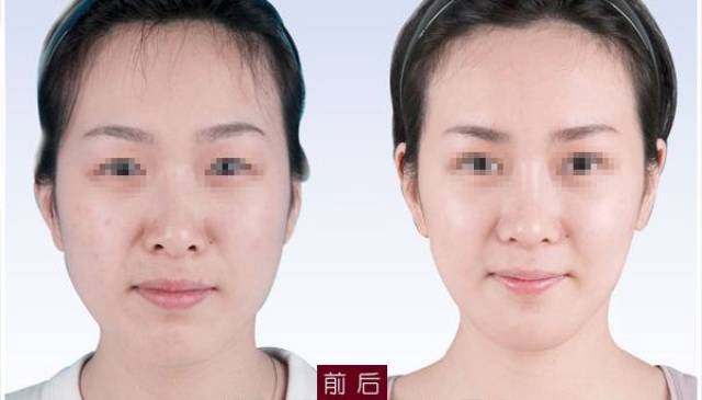 什么是颞部填充用自体脂肪填充颞部效果好吗