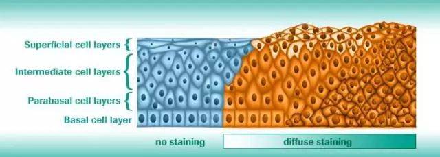 宫颈鳞状上皮内病变p16免疫组化解读