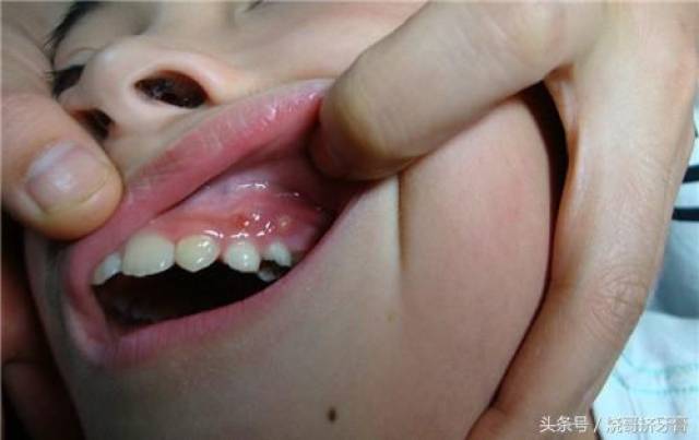 牙龈上长脓包到底有多痛?