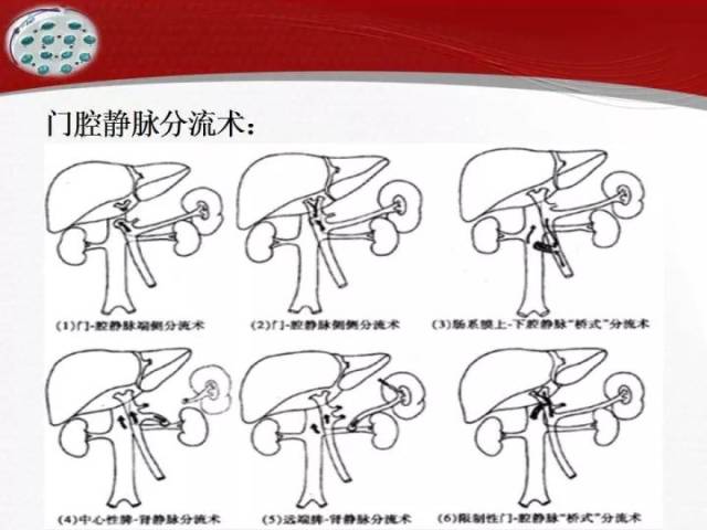 门奇静脉断流术图片