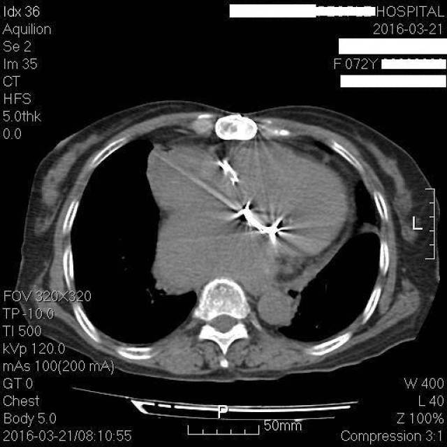 心外科的医师看了胸部ct,这机械瓣,这伪影像闪动的光芒,可惜照不亮她