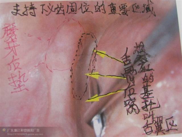 【收藏】无牙颌,活动义齿取模技巧