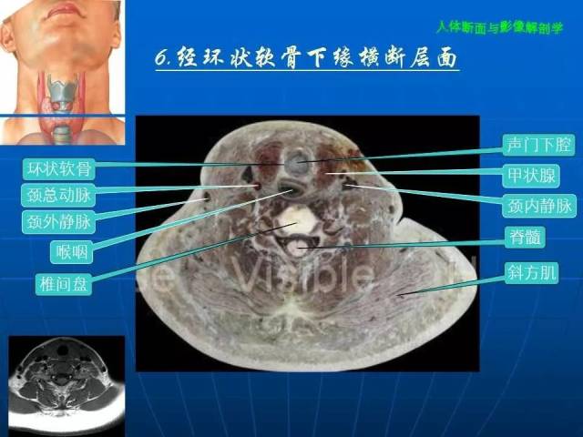 颈部断面与影像解剖