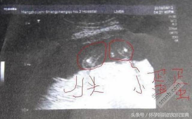 怀孕肚子中线看男女图图片