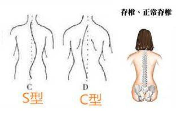 高低肩仅仅是不美观?可能是脊柱侧弯的信号!