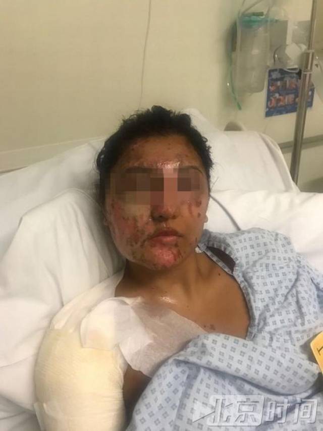 21岁女子被泼硫酸毁容,4个月后奇迹恢复