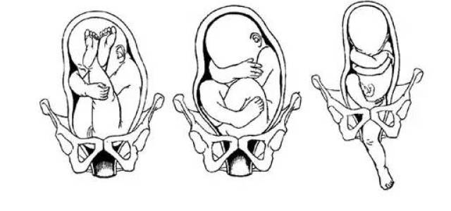 头位: 头位分为: 枕先露,前顶先露,额先露,面先露