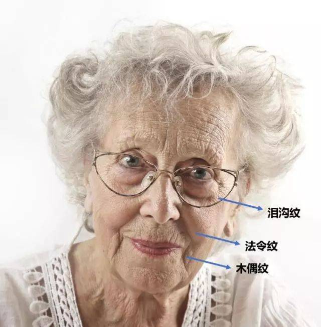 有了第一条三八线泪沟纹