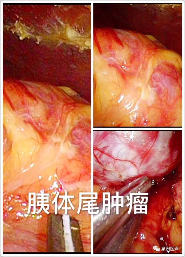 腹股沟恶性肿瘤图片