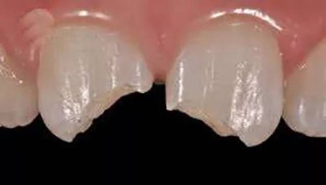 分享牙齿外伤的紧急处理方法