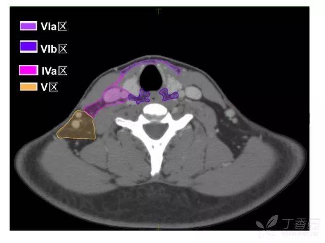 纵隔淋巴结位置图CT图片