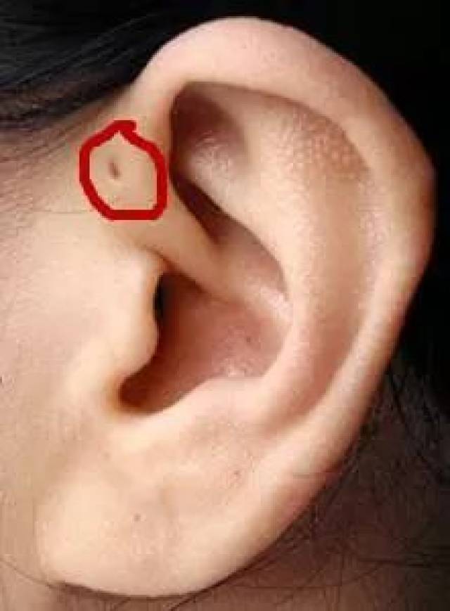 小时候听长辈说这叫"仓眼",并且认为长有这种小洞将来会使宝宝大富大