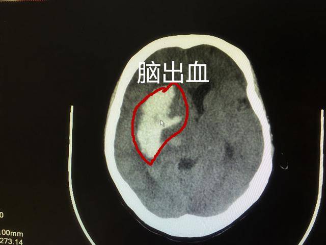 带你全面了解高血压脑出血手术治疗