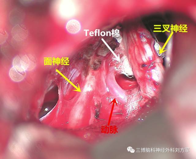 有血管与三叉神经接触,用teflon垫开 术后恢复好.