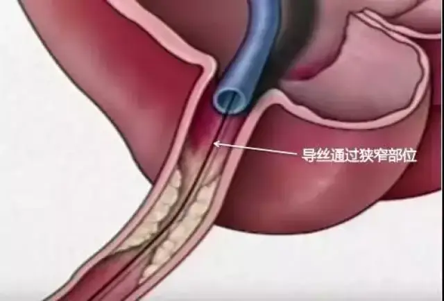 胆管支架手术过程图片图片