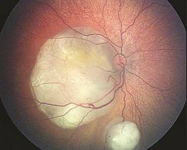 儿童视网膜母细胞瘤图片