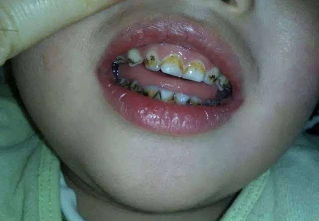 儿童蛀牙可怕图片