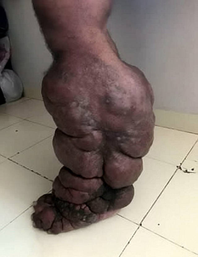印男子被蚊子叮咬患巨腿病 左腿是正常四倍大