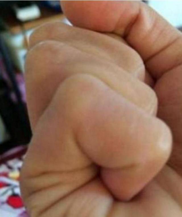 双重婚姻线,是指手掌中有两条平行的婚姻线.