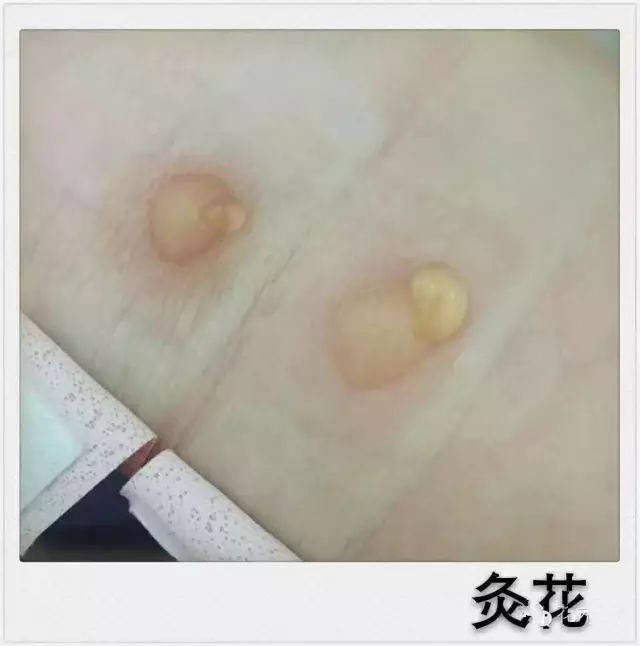 如果出水泡說明你體內溼氣較重,如果水泡是無色的,說明是寒溼,如果