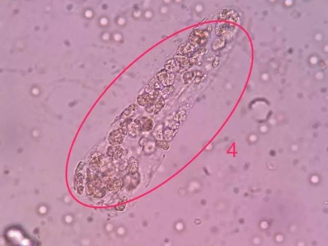 尿液管型图片分享,细胞图片分享疟原虫专辑