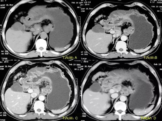 看了这篇 晋级胃癌 ct 诊断高手