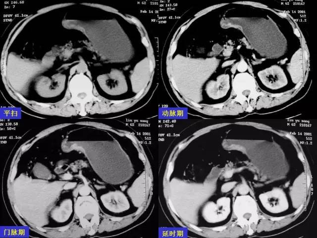 看了这篇 晋级胃癌 ct 诊断高手