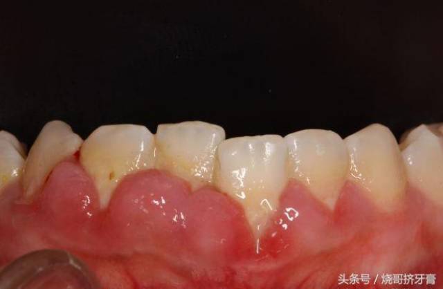 牙周炎要切掉牙龈到底有多恐怖