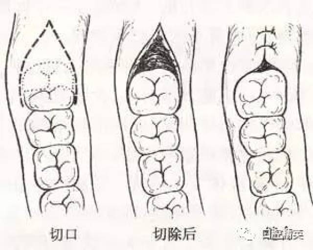 行冠周盲袋冲洗,然后在隔湿条件下,用探针蘸碘酚或10%碘合剂烧灼盲袋