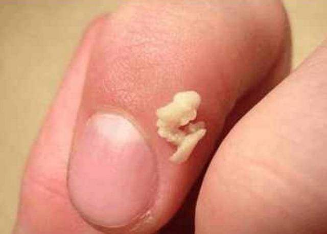 从喉咙里咳出来的这些白色颗粒闻一下味道非常的臭