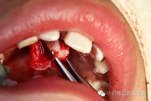 一例变异中切牙埋伏倒置,酷似"蜗牛"!