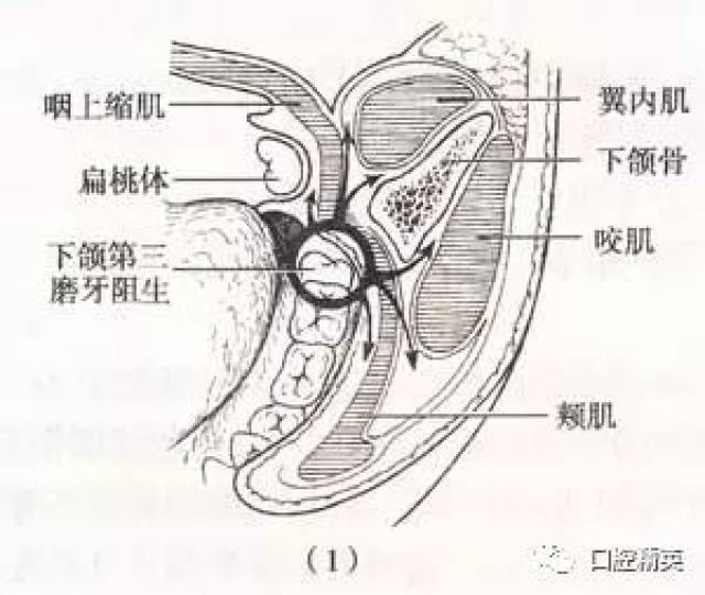 下颌前庭沟位置图图片