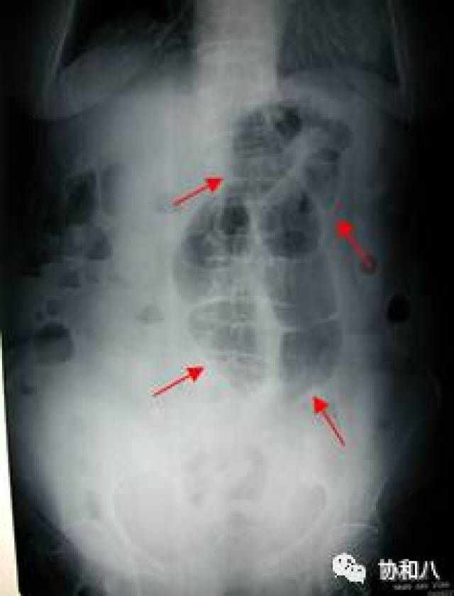 液平肠袢助君识——肠梗阻的识别和鉴别诊断 | 一页手册 · 协和八
