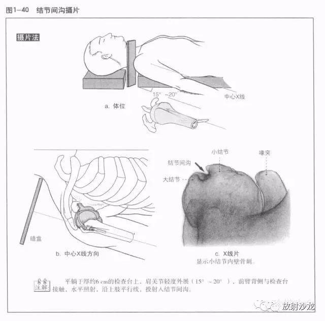 (1)鎖骨的x線解剖在後前位x線片上,長管狀的鎖骨,重疊在肺尖部,把胸骨