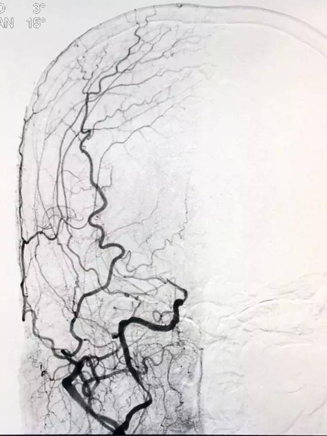 李氏电凝法血管内治疗颅内微小动脉瘤