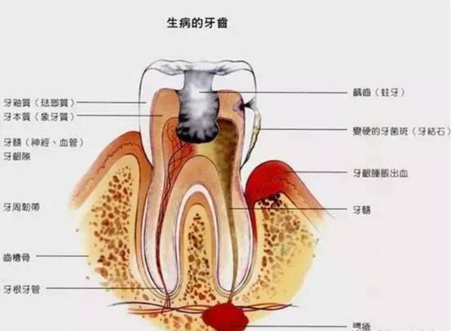 首先应明确什么是牙髓 牙髓组织位于牙齿内部的牙髓腔