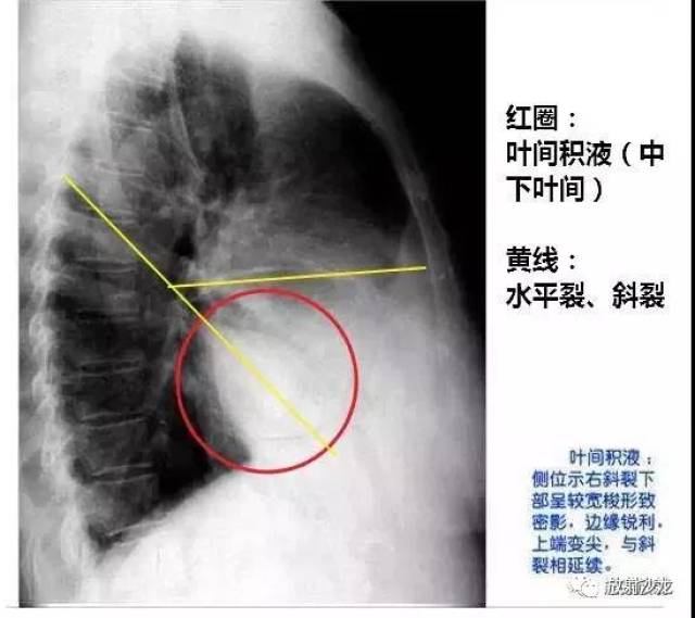 胸腔积液图片对照图片